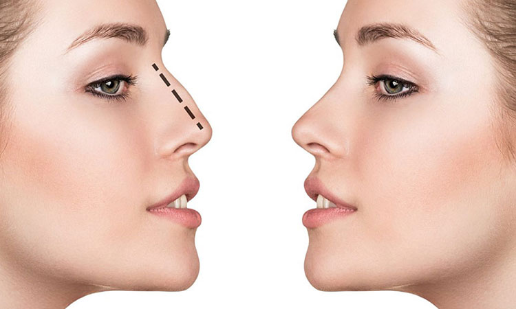 Burun əməliyyatı öncəsi